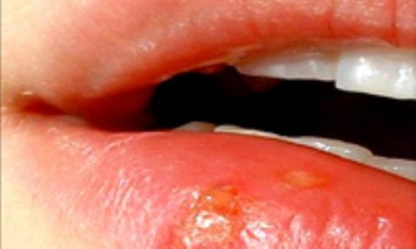 نسخه تبخال را بپیچید! نسخه تبخال را بپیچید!