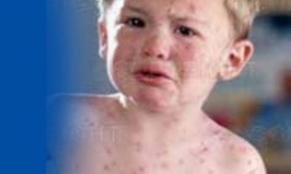 الفبای آبله مرغان