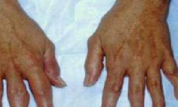 آرتریت روماتوئید در یک نگاه