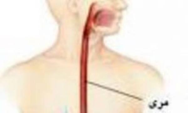 تنگی مری یا ازوفاژیت خورنده