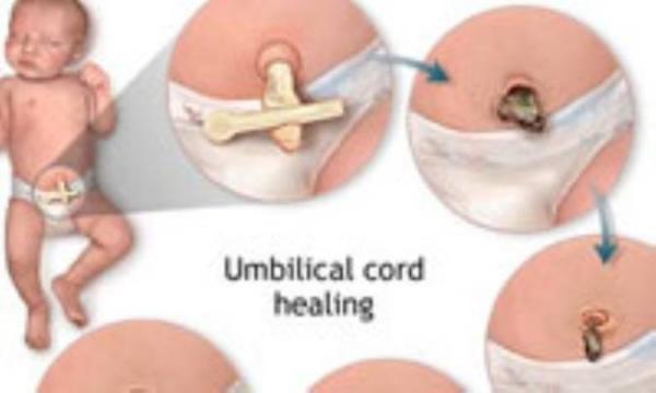 مراقبت از بند ناف در نوزاد تازه متولد شده