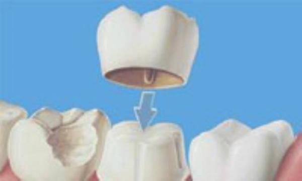 ترمیم لبخند با روکش چینی ترمیم لبخند با روکش چینی