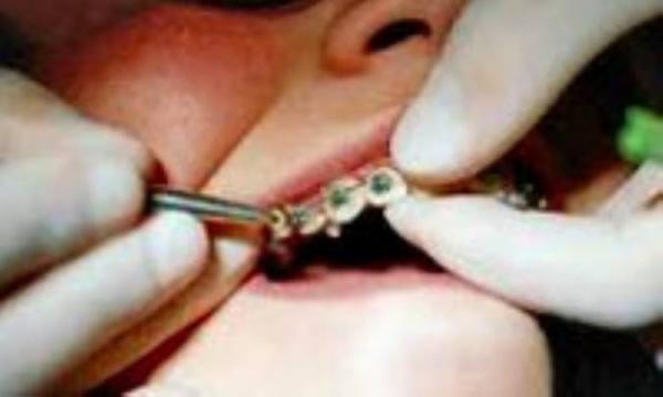 تابستان، فصل ارتودنسی