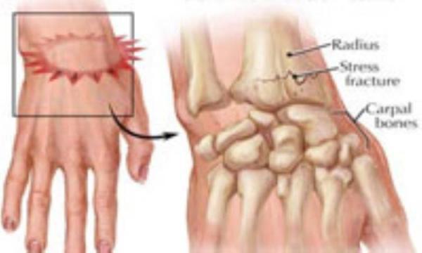 یاری های اولیه آسیب های دست و انگشتان