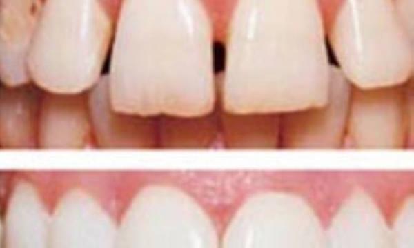 بین دندان هایتان فاصله است؟