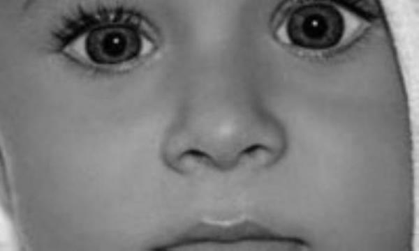نگذارید چشم نوزادتان تنبل گردد