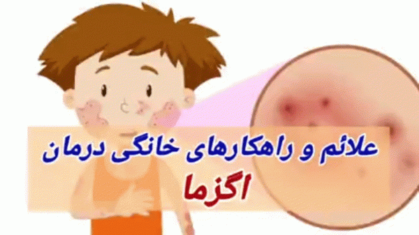 علائم و راهکارهای خانگی درمان اگزما علائم و راهکارهای خانگی درمان اگزما