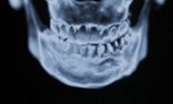 سندرم (سندرم مفصل گیجگاهى فکى)