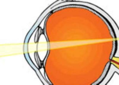 پیرچشمی (Presbyopia) چیست و چگونه پیشگیری و درمان می گردد ؟