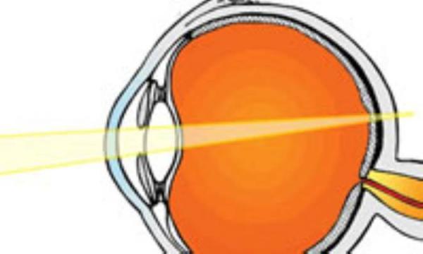 پیرچشمی (Presbyopia) چیست و چگونه پیشگیری و درمان می گردد ؟