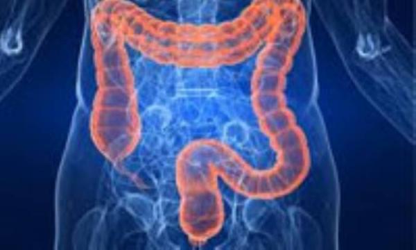 هموروئید (بواسیر)