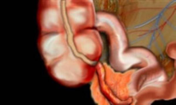 آپاندیس و آپاندیسیت