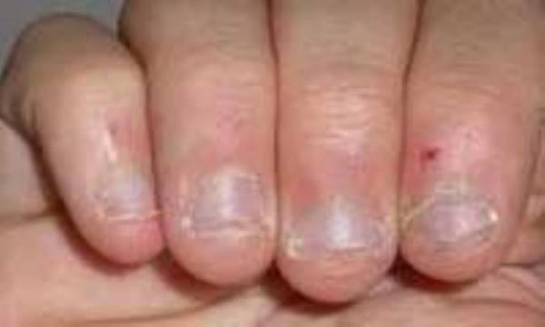 ریشه شدن پوست اطراف ناخن