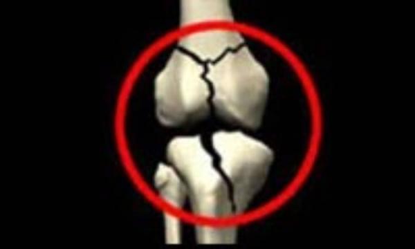 کمبود ویتامین کا (K) و تأثیر آن بر سلامت استخوان