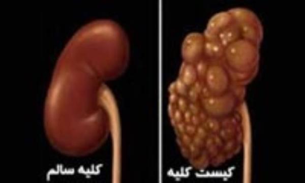 درمان کیست کلیه