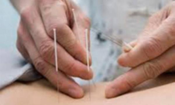 طب سوزنی برای کاهش وزن طب سوزنی برای کاهش وزن