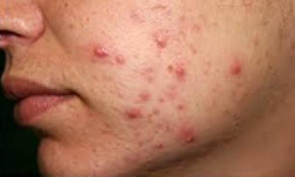 پاکسازی طبیعی آکنه