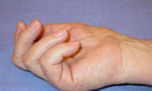 سندرم گیر افتادن عصب مچ دست سندرم گیر افتادن عصب مچ دست