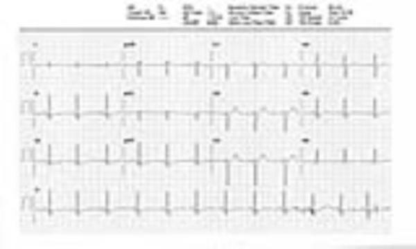 ضربان قلب پایین
