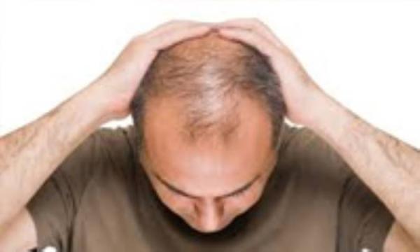 ویتامین های طبیعی ضروری برای جلوگیری از ریزش مو در زنان