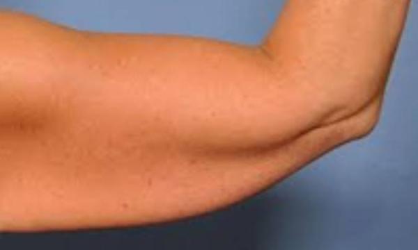 چگونه به سرعت از شر بازوهای شل و آویخته خلاص شوید