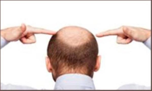 کمبود پتاسیم و ریزش مو کمبود پتاسیم و ریزش مو