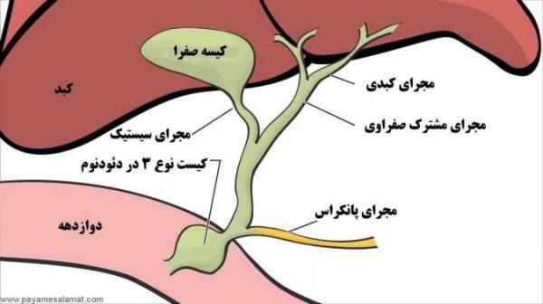 درمان سرطان مجرای صفراوی
